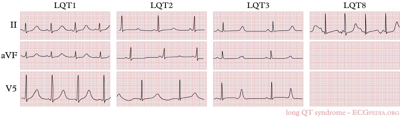 LQTS ECG Patterns by Genotype